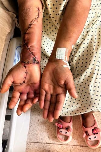 IMSS Bienestar realiza intervención multidisciplinaria que evita amputación tras mordedura de araña violinista, en Hidalgo